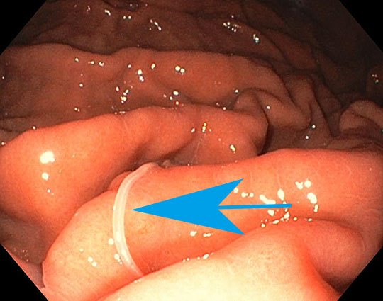 アニサキス症になったらどうしたらいい?