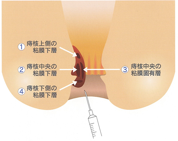 痔核硬化療法(ジオン注射・ALTA療法)はいぼ痔を「固めて」しまう
