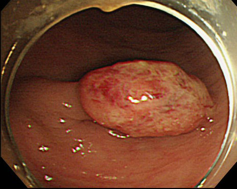 大腸ポリープと大腸がん