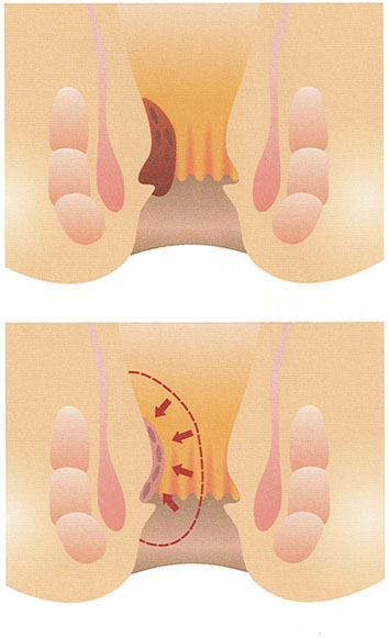 いぼ痔は手術しなくても治る?いぼ痔には注射の治療もあります