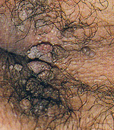 おしりの周りにいぼができていませんか?