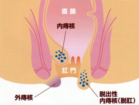 いぼ痔とは何なのか?