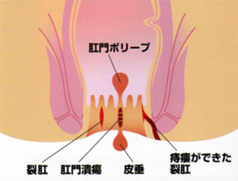 肛門が痛い – きれ痔(裂肛)について
